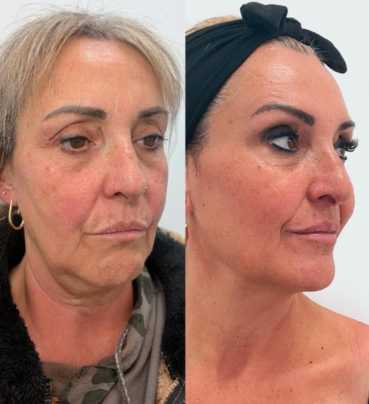 Antes y después 2
