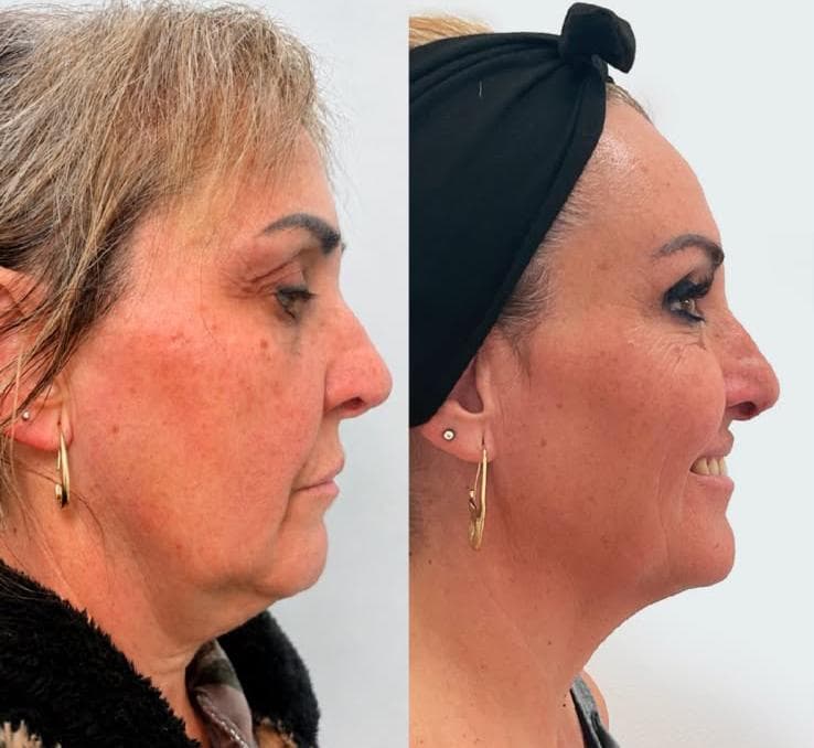 Antes y después 3
